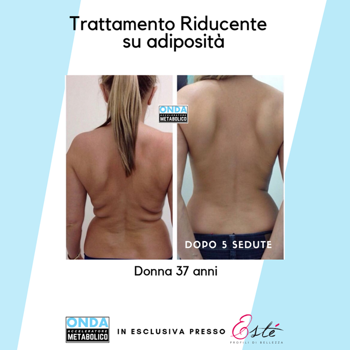 Storz Medical onda acustica cellulite tonificazione centro estetico Prata di Pordenone 