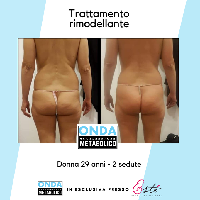 Storz Medical onda acustica cellulite tonificazione centro estetico Prata di Pordenone 