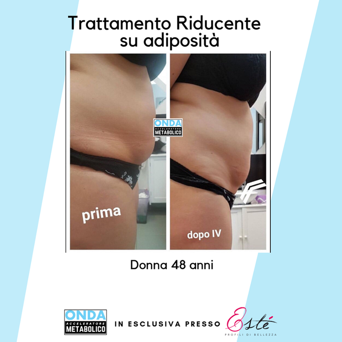 Storz Medical onda acustica cellulite tonificazione centro estetico Prata di Pordenone 