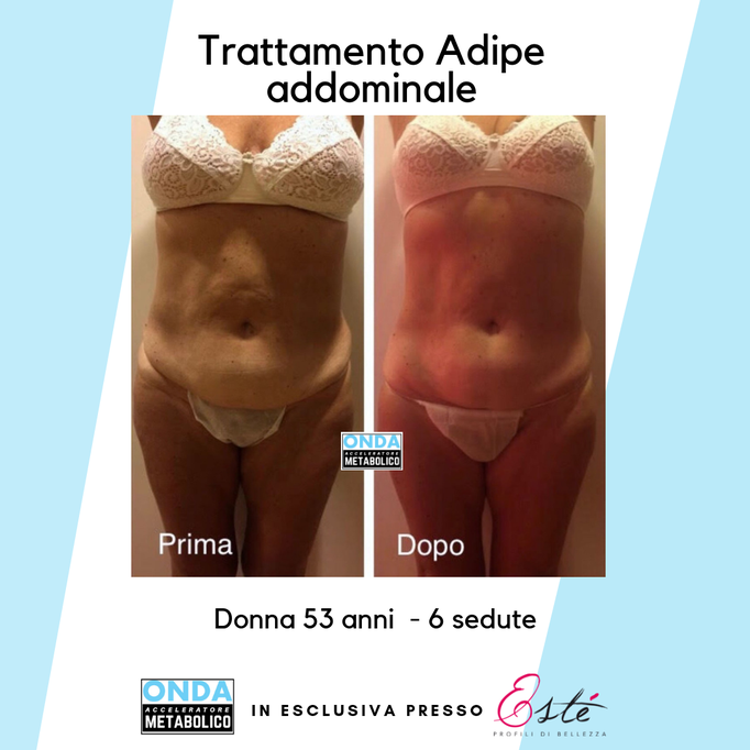 Storz Medical onda acustica cellulite tonificazione centro estetico Prata di Pordenone 