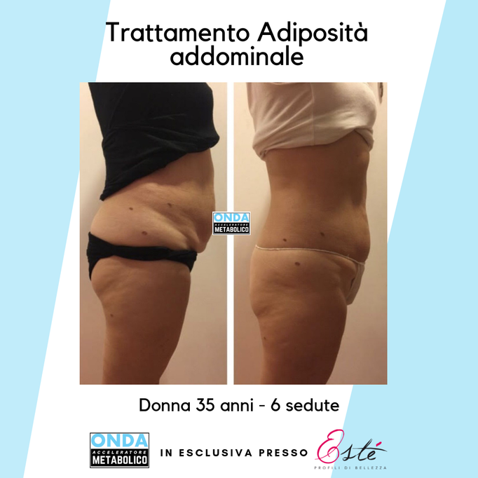 Storz Medical onda acustica cellulite tonificazione centro estetico Prata di Pordenone 