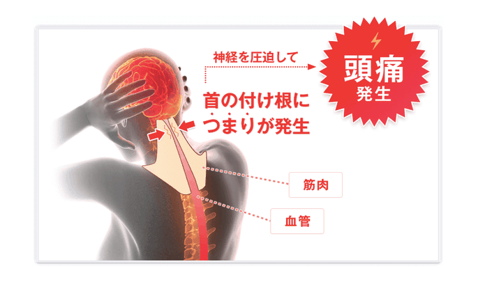 頭痛が発生する仕組みを説明する画像
