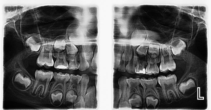 Comfortable Bitewing x-rays