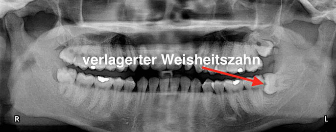 Röntgenbild eines verlagerten Weisheitszahnes 38