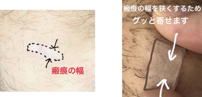 瘢痕の幅を広げないために大切な、テープによるキズアト固定