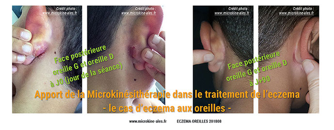 Eczema oreilles Microkinésithérapie Traitement