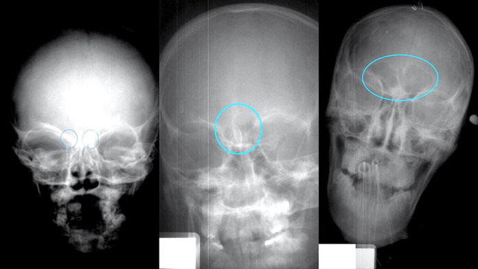 Sinus X-rays