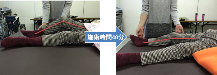 右膝の拘縮が改善　膝を伸ばせる