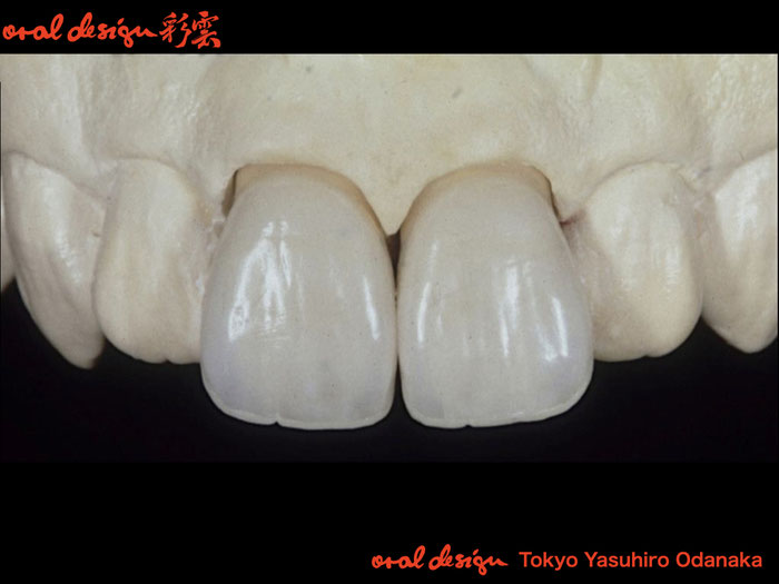 ・模型上での完成したメタルセラミックスクラウン。模型上での歯肉の高さに注目。模型上では歯根が出ている状態になっている。