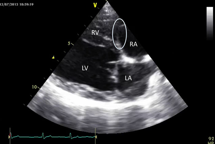 heart with tricupid valve dysplasia