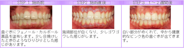 八戸　歯茎ピーリング　ホワイトニング　メラニン除去　