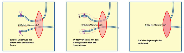 Vasektomie und Vasoresektion in München Teil 3