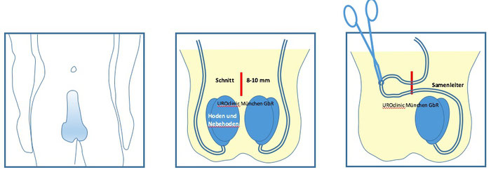 Vasektomie und Vasoresektion in München Teil 1