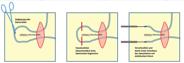 Vasektomie und Vasoresektion in München Teil 2