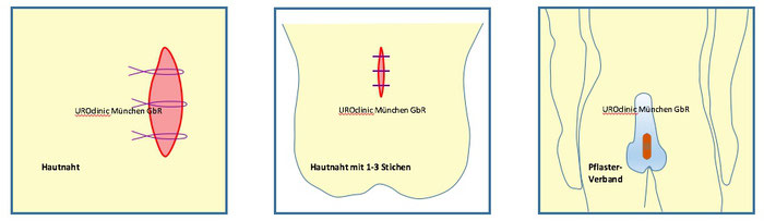 Vasektomie und Vasoresektion in München Teil 4