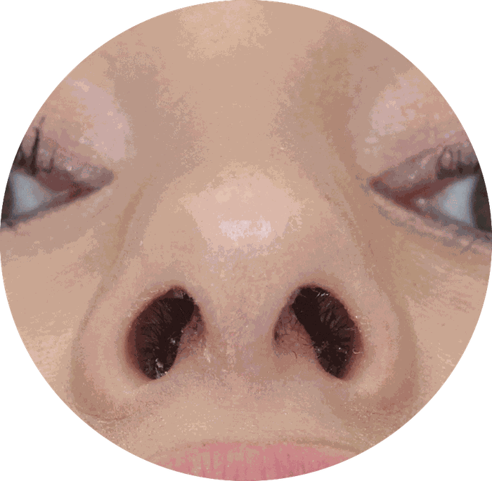 Open nose surgery Hamburg Dr. Kovacevic