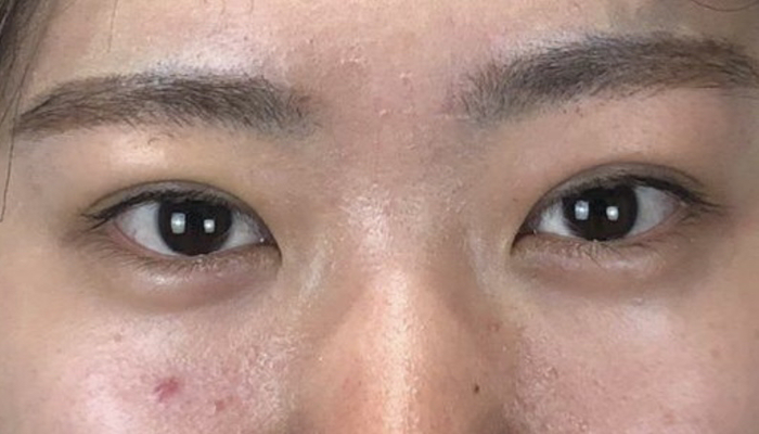 埋没4点法の画像