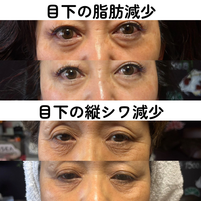 小顔ハイフ・ボディハイフ痩身メニュー - Barberはなちゃん 小顔ハイフ・ボディハイフ痩身メニュー - Barberはなちゃん