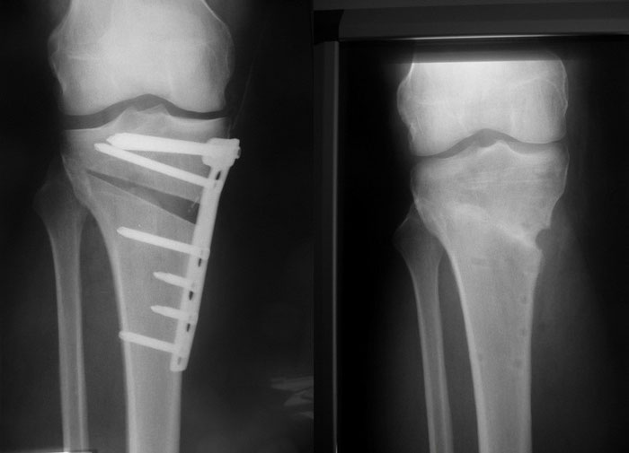Xund OBein, Beinachsen korrektur motioncare sandra leupin