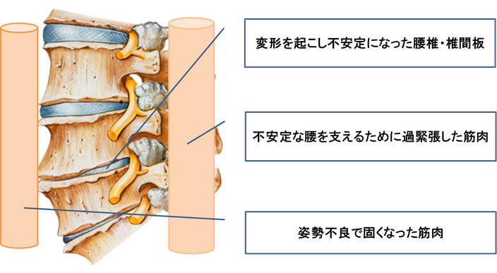 腰椎や椎間板の変形は腰を不安定にし腰痛の原因になることがあります