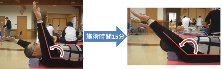 施術時間15分　右肩の痙縮・拘縮改善