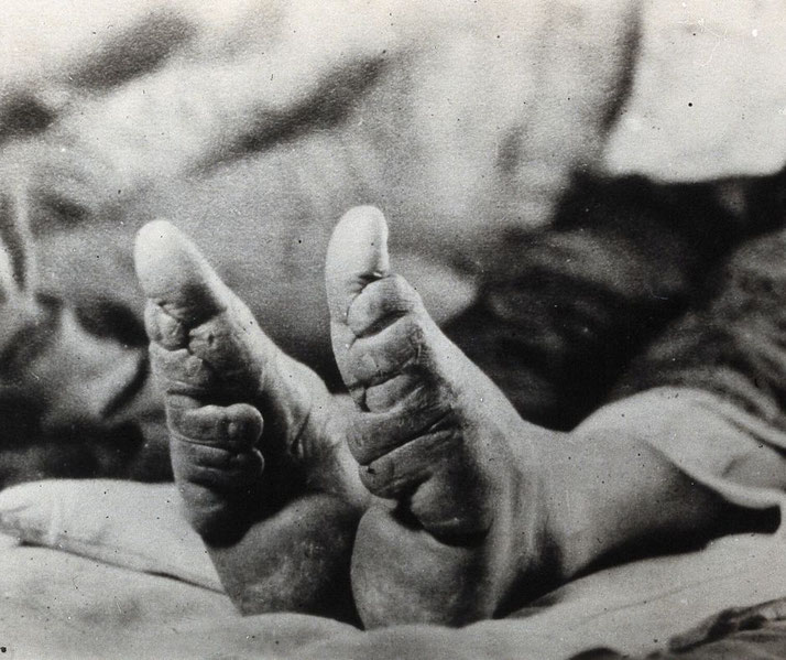A black-and-white photograph showing the deformed feet of a Chinese woman, a result of the historical practice of foot binding. 