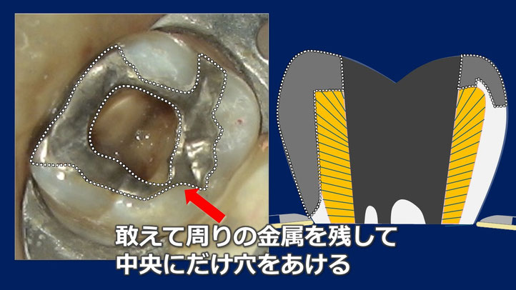 根管治療での正しい歯の削り方。詰め物を完全に除去してはならない。歯の周りを残すのが鉄則です