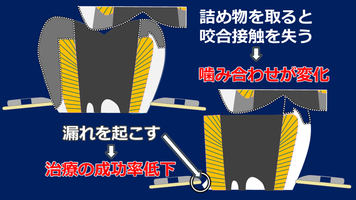 米国では修復物は外さず治療が行われます。修復物を外すと、感染のリスクと咬合の崩壊のリスクを増加させることになります。