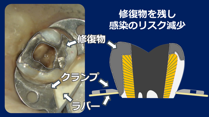 根管治療での正しい歯の削り方。詰め物を完全に除去してはならない。歯の周りを残すのが鉄則です