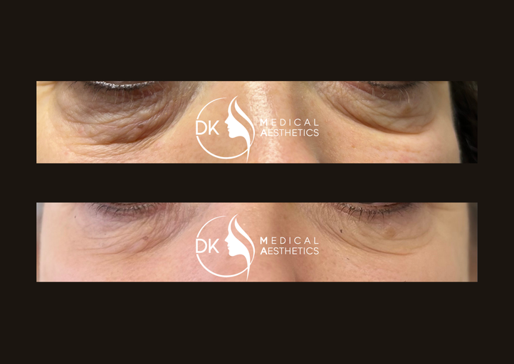 Before & After Under Eye Treatment with Polynucleotides