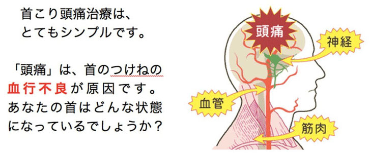 あなたの首はどんな状態ですか？　頭痛専門院マニッシュ