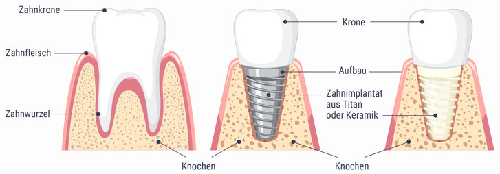 Zahnimplantate aus Titan oder Keramik | Dr. Becker Zahnarztpraxis im Seefeld Zürich