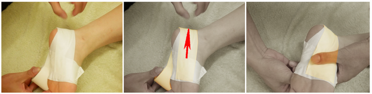 足底腱膜炎（足底筋膜炎）のテーピング貼り方