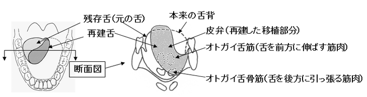 図２　或る舌癌患者の舌の状態