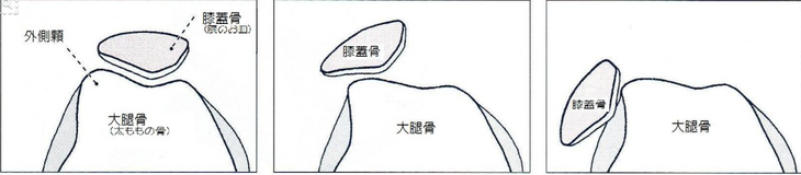 膝蓋骨(膝のお皿)の形状