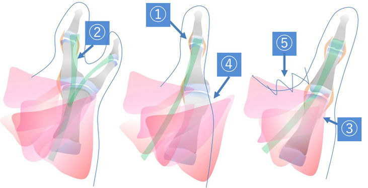 母指多指症の手術概要