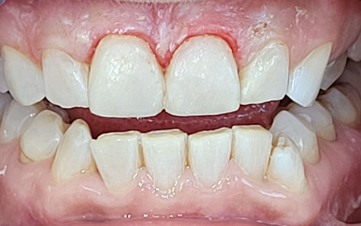 Nach dem Bleaching und Composit Aufbau (Dauer insgesamt: 4 Stunden, Kosten: 1300 CHF)