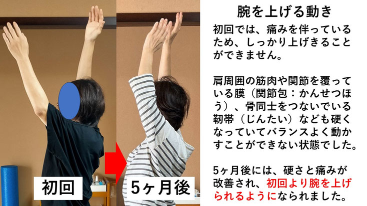 五十肩の施術例。初回から5か月後にかけて肩の可動域が改善し、腕を痛み無く上に上げられるようになった症例