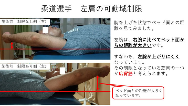 野球 野球肩 肩が痛い ピッチャー リトルリーガーズショルダー 腱板損傷 投球傷害 水泳 競泳 腰痛 分離症 分離すべり症 水泳肩スイマーズショルダー 水泳肩 スイマーズショルダー治療 スイマーズショルダー治るのか 岐阜 岐阜市 岐阜市茜部 岐阜市東鶉 岐阜市南鶉 岐阜市中鶉 岐阜市柳津町 羽島市 羽島郡 笠松町 岐南町 茜部 鶉 東鶉 中鶉 南鶉 柳津 笠松
