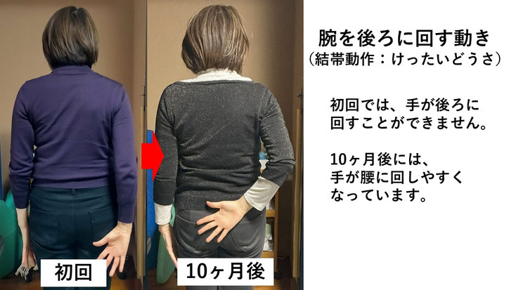 五十肩の施術例。初回から10か月後にかけて肩の可動域が改善し、腕を後ろに回せるようになった症例。