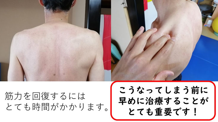 五十肩の60代男性。発症から1年後に来院し、施術3か月で肩関節の可動域は改善したものの、インナーマッスルの筋萎縮により左腕を十分に上げられない状態。