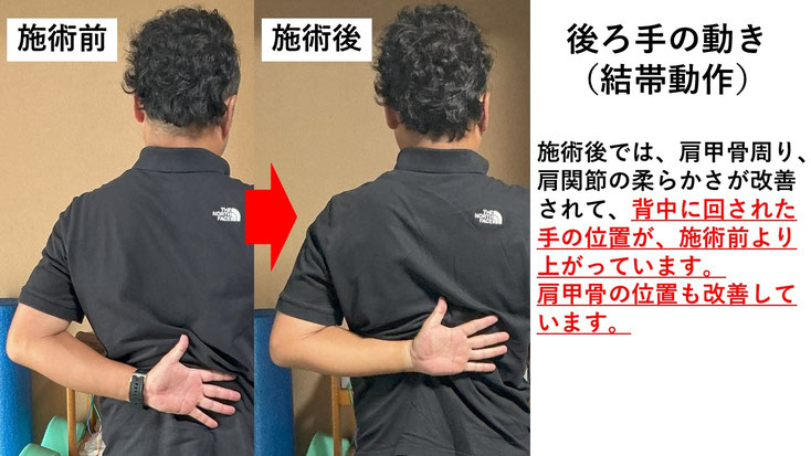 五十肩の施術例。初回の施術前後で肩の痛みと動きのスムーズさが改善した症例。