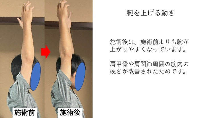 右投げ高校生キャッチャーの野球肩施術前後の腕を上げる動きの比較