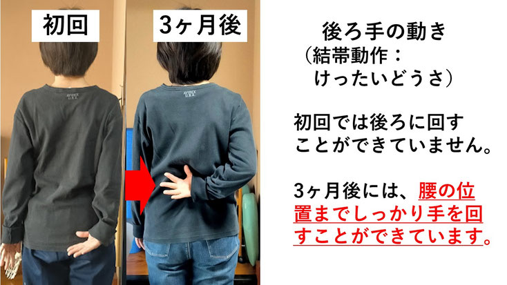五十肩の施術例。初回から3か月後にかけて肩の可動域が改善し、腕を痛み無く後ろに回せるようになった症例