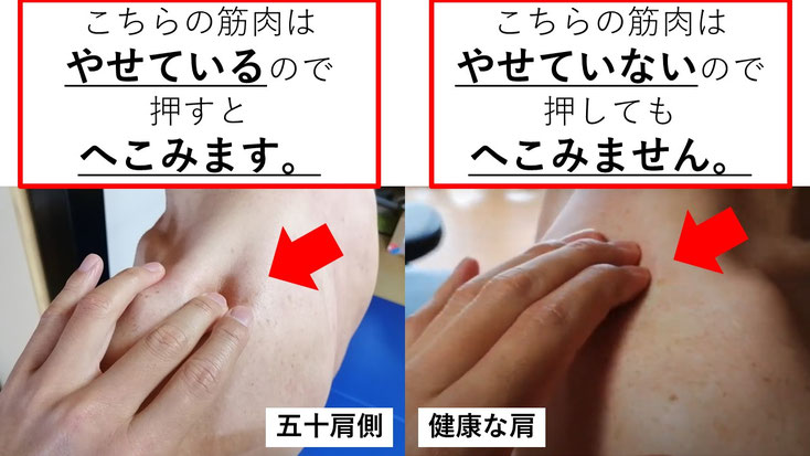 五十肩の60代男性。発症から1年後に来院し、施術3か月で肩関節の可動域は改善したものの、インナーマッスルの筋萎縮により左腕を十分に上げられない状態。