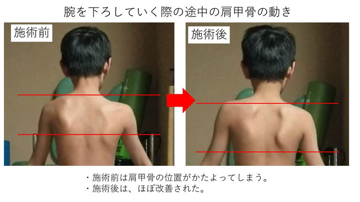 肩関節の痛み　姿勢　肩甲骨　肩甲骨痛み　背中の痛み　野球肩の原因　野球肩原因　野球肩治し方　野球肩体操　野球肩ストレッチ　野球　野球肩　肩が痛い　ピッチャー　リトルリーガーズショルダー　腱板損傷　投球傷害　水泳　競泳　腰痛　分離症　分離すべり症　水泳肩スイマーズショルダー　水泳肩　スイマーズショルダー治療　スイマーズショルダー治るのか　岐阜　岐阜市　岐阜市茜部　岐阜市東鶉　岐阜市南鶉　岐阜市中鶉　岐阜市柳津町　羽島市　羽島郡　笠松町　岐南町　茜部　鶉　東鶉　中鶉　南鶉　柳津　笠松　