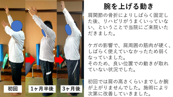 五十肩の施術例。初回から3か月後にかけて肩の可動域が改善し、腕を上げられるようになった症例。