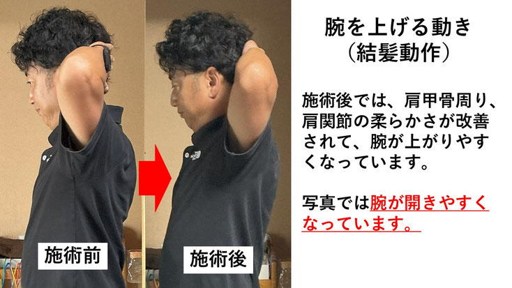 五十肩の施術例。初回の施術前後で肩の痛みと動きのスムーズさが改善した症例。