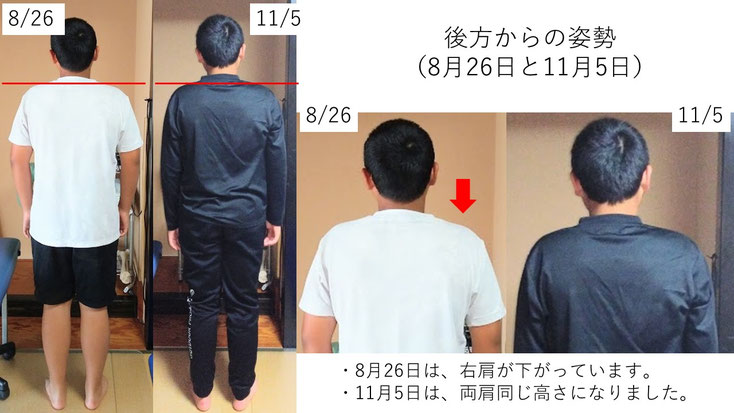 肩関節の痛み 姿勢 姿勢改善 肩甲骨 肩甲骨はがし 肩甲骨痛み 背中の痛み 野球肩の原因 野球肩原因 野球肩治し方 野球肩体操 野球肩ストレッチ 野球 野球肩 肩が痛い ピッチャー リトルリーガーズショルダー 腱板損傷 投球傷害 水泳 競泳 腰痛 分離症 分離すべり症 水泳肩スイマーズショルダー 水泳肩 スイマーズショルダー治療 スイマーズショルダー治るのか 岐阜 岐阜市 岐阜市茜部 岐阜市東鶉 岐阜市南鶉 岐阜市中鶉 岐阜市柳津町 羽島市 羽島郡 笠松町 岐南町 茜部 鶉 東鶉 中鶉 南鶉 柳津 笠松