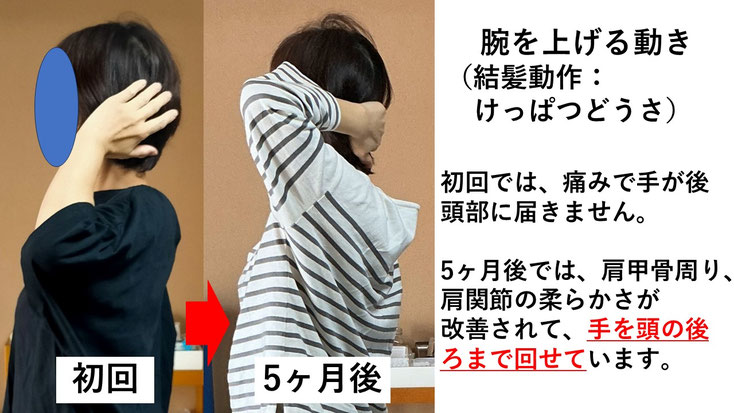 五十肩の施術例。初回から5か月後にかけて肩の可動域が改善し、腕を痛み無く頭の後ろに回せるようになった症例